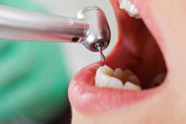 Best Emergency Dental Extractions in Lamar, SC